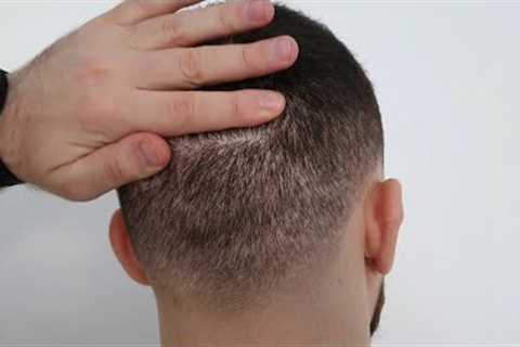 FUE Hair Transplant 8 MONTHS Results | Overharvested Donor Area?