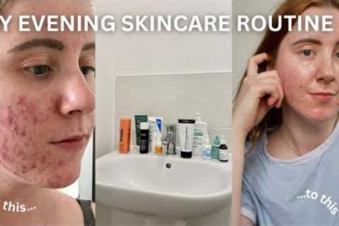 An Evening Skincare Routine For Acne-Prone Skin THAT REALLY WORKS!