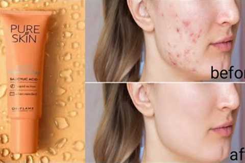 Summer acne problems/Solution in this video|Full details| Must watch this video