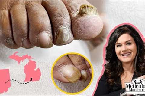 👣Thick Big Toenails from Indiana Find Help in Michigan👣