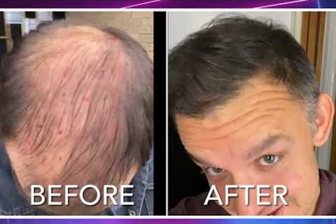I had PRP (platelet rich plasma) therapy for hair loss instead of a hair transplant. (Part 1)