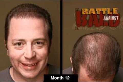 Bosley Hair Transplant Results After 12 Months (Time Lapse)
