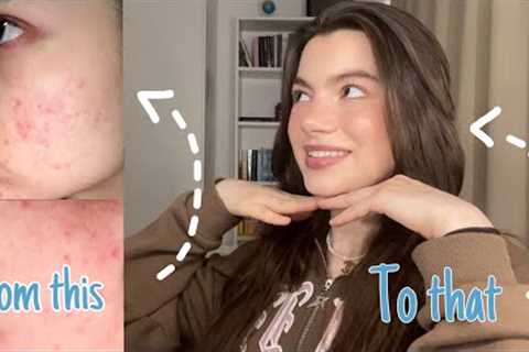 How I got rid of my Acne in 2 Weeks!! (My morning Skincare Routine)