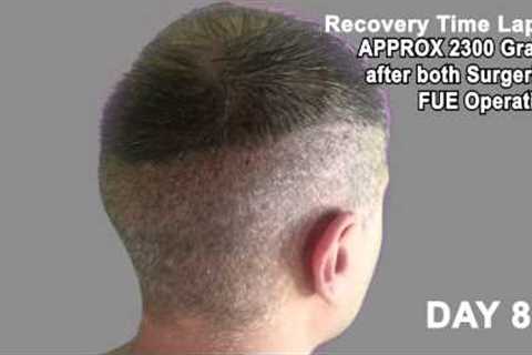 Hair Transplant Review 2013 19 DAY RECOVERY TIME LAPSE OF DONOR AREA POST OP