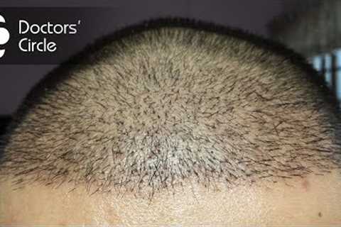 How long does it take for hair to grow after a hair transplant? - Dr. Madan Kumar BJ