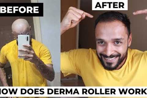 Derma Roller hair regrowth before and after | Does Micro-needling actually work in reducing DHT?