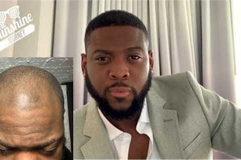 Fue Hair Transplant Time lapse | Day 1 to Day 365 | Before &amp; After