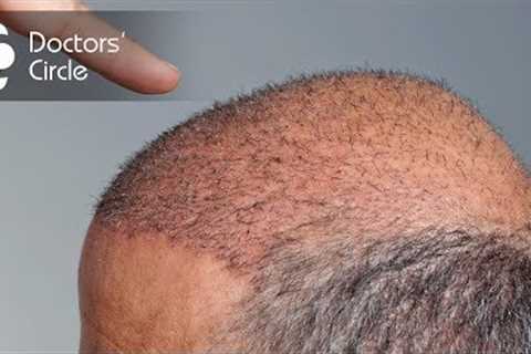 When will newly transplanted hair start to grow? - Dr. Niranjana Raj