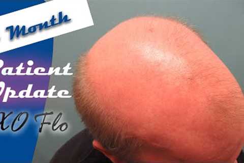 Norwood 7 Hair Loss Treatment - Patient Update with Adam