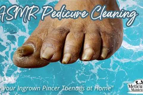 👣ASMR Pedicure Cleaning💆‍♀️Fix your Ingrown Pincer Toenails at Home👣
