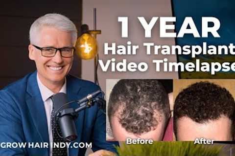 Hair Transplant - 1 Year Video Timelapse - We Grow Hair Indy