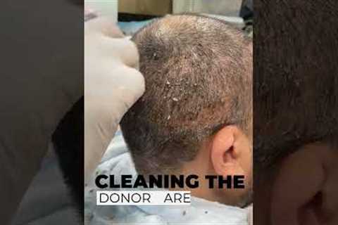 Head Wash After Hair Transplant | 1st Head Wash | Scabs Removal
