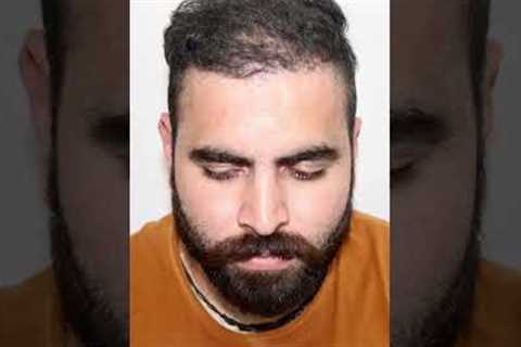 Two Years Hair Transplant Results | Latest Fue Technique #shorts #viral #hair transplant