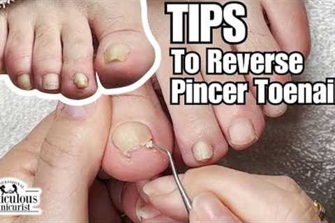 Pincer Toenail Transformation at Home #nails #satisfying