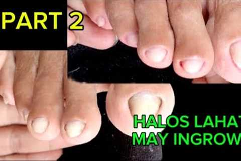 PART 2 PEDICURE KUTKOT INGROWN// VLOG 23 #shietv