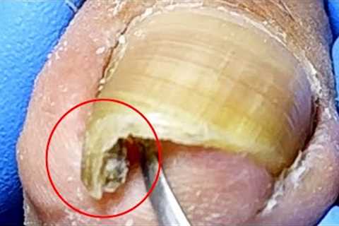 The sharp ingrown toenails are very prominent, so cut them cleanly【Xue Yidao】