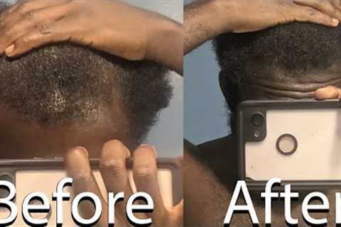 Male Pattern Baldness: The “Cure”