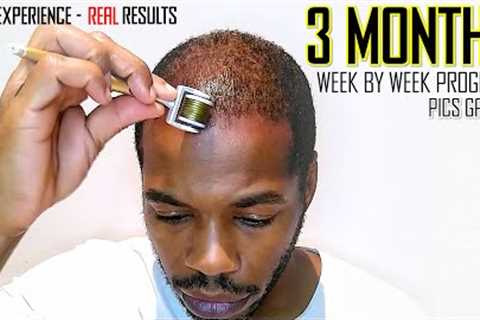 Derma roller Hair Regrowth Results 3 Months | Month by Month Progress