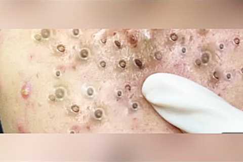 Relaxing video of blackhead &amp; acne popping #pimplepopper#pimplepopping #acne#viral..