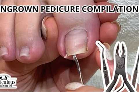 This Painful Ingrown Toenail was Fixed with Pedicure Tools