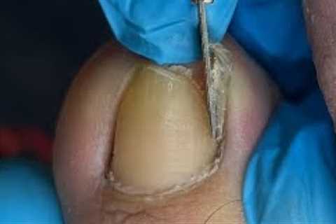 Huge ingrown toenail removal