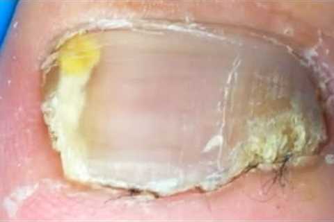 There are bad nails on both sides of the toenails, trim them thoroughly【Crazy pedicure room】