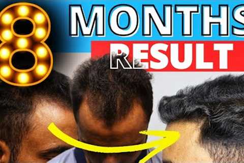 8 Months Hair Transplant Result | Before &amp; After | HairMate Clinic Hair Transplant