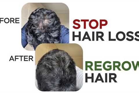 How To Stop Hair Loss &amp; Regrow Hair I Hindi I Complete Guide Of Hair Care