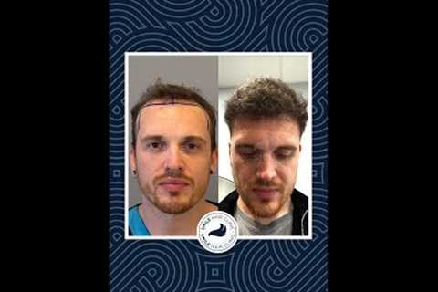 Hair Transplant - 8 Months Result!