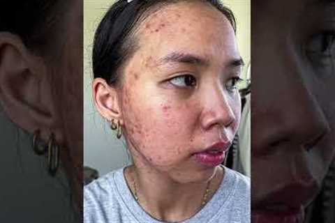 acne journey 🫶🥺 #shorts #acne #acnejourney #acneproneskin #acnetreatment