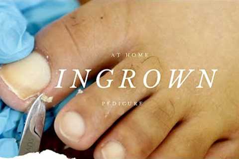 INGROWN TOENAIL PEDICURE AT HOME