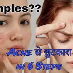 How To Remove Pimples | How To Get Rid Of Pimples | Acne #video #viralvideo #youtubevideo #acne #diy