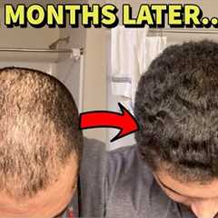 BALD GUY REVERSES HAIR LOSS IN 2 MONTHS! HERE'S WHAT HE DID!