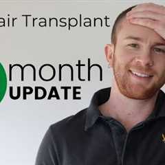 3 MONTH FUE Hair Transplant Results