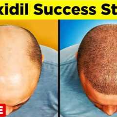 MINOXIDIL - A Step-by-Step Guide to Regain Your Hair