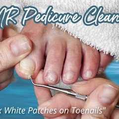 👣ASMR Pedicure Cleaning💆‍♀️How to Fix White Patches on Toenails👣