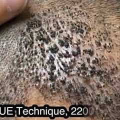 How scalp look after 10th day of Hair Transplant?