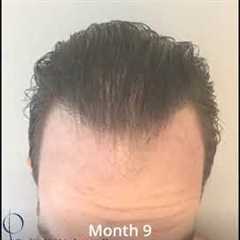 TimeLapse of Hair Transplant Growth