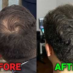 how i reversed balding