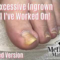 Most Extreme Ingrown Toenail Salon Pedicure - Shortened