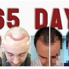 DAY 1 to DAY 365: a Picture a Day after a Hair Transplant [TIME-LAPSE]