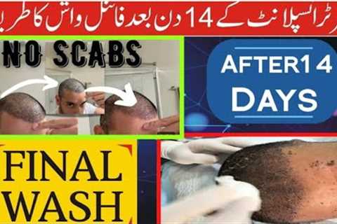 14 Day Hair Transplant final Wash || How To Final Wash at home || Hair Transplant after final Wash |