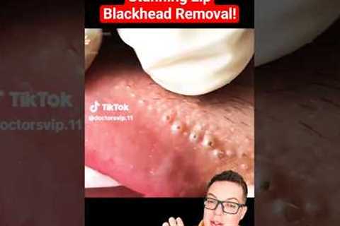 Crazy Painful BLACKHEAD REMOVAL AROUND LIPS - Super Satisfying #shorts