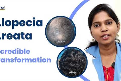 Alopecia Areata | How We Restored Hair Growth? Amazing Transformation With Alopecia Treatment Kit