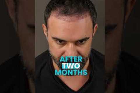 Hair Transplant Time Lapse at Vera Clinic #shorts #hairtransplant #hairtransplantturkey