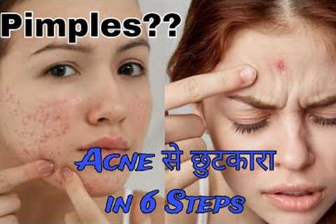 How To Remove Pimples | How To Get Rid Of Pimples | Acne #video #viralvideo #youtubevideo #acne #diy