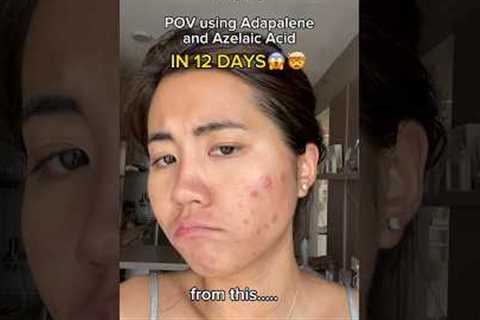 Adapalene + Azelaic Acid Miracle Combo in 12 Days😍