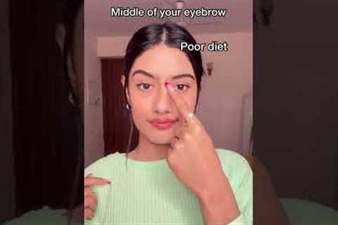 What your Acne means ⁉️ #ashortaday #shortsvideo #acne