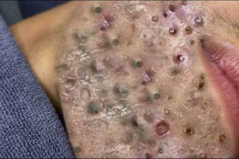 Acne Extraction Whiteheads Removal Pimple Popping#706