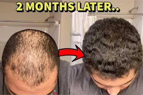 BALD GUY REVERSES HAIR LOSS IN 2 MONTHS! HERE'S WHAT HE DID!